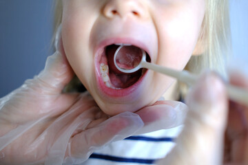dentist, doctor examines oral cavity of small patient, uses mouth mirror, closeup baby teeth child, concept pediatric dentistry, dental treatment, correction of occlusion, oral care, caries prevention