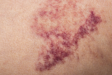 Hematoma wound on human skin