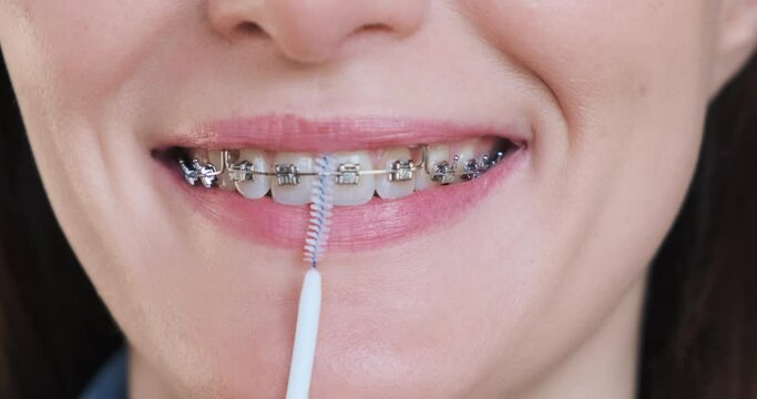 Close-up, woman cleaning braces by orthodontic brush, smiles. Dental braces system hygiene, dentistry care concept. Cropped smiling female face, brushing metal self-ligating brackets by toothbrush