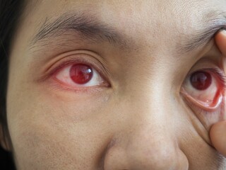 Close up of two annoyed red blood eyes of asian woman affected by conjunctivitis or after flu, cold...