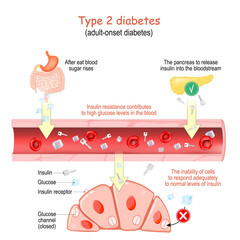 Type 2 diabetes. adult-onset diabetes. - obrazy, fototapety, plakaty