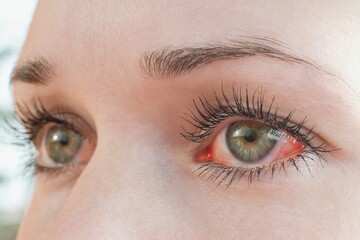Red irritated human eye close up, allergy symptom - obrazy, fototapety, plakaty