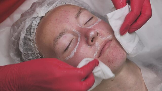 Wipe the mask off the face of a girl with problematic koja with cotton pads.