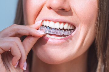 Woman with perfect smile wearing invisible dental aligners for dental correction - obrazy, fototapety, plakaty