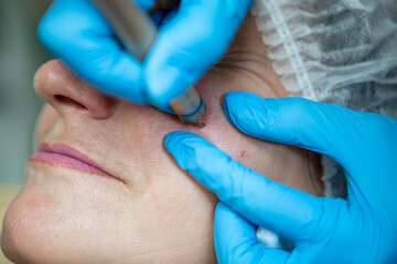 Removal of red spots, rosacea, blood vessels, on the face of a Caucasian woman. Laser apparatus. 