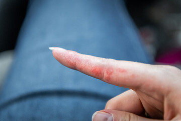 Macro closeup of red patches on index finger skin of female young woman's hand showing eczema...