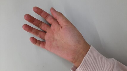 Obraz premium The problem of rashes on the skin of the hands. Red rash on a child's hand.