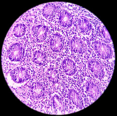 Appendix, Acute appendicitis, show vermiform appendix wall, infiltration of neutrophils in all the layers including muscle layers, 40x microscopic image.