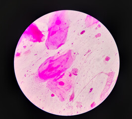 Gram stain: Gram positive cocci, Gram positive diplococci bacteria, candida present, squamous...