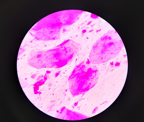 Prostatic smear for Gram Staining microscopic 100x show Neisseria gonorrhoeae bacteria. Gonorrhea...