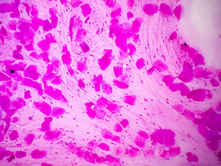 High Vaginal Swab (HVS) gram stained microscopic 100x zooming show gram positive Diplococci...