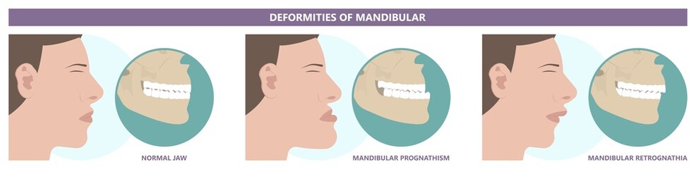 Jaw Surgery chin implant Sleep Apnea snoring upper airway plastic facial Cranio TMD TMJ joint Overbite teeth dental birth defects Open bite pain trauma cosmetic gummy smile bone reconstructive bad © Pepermpron