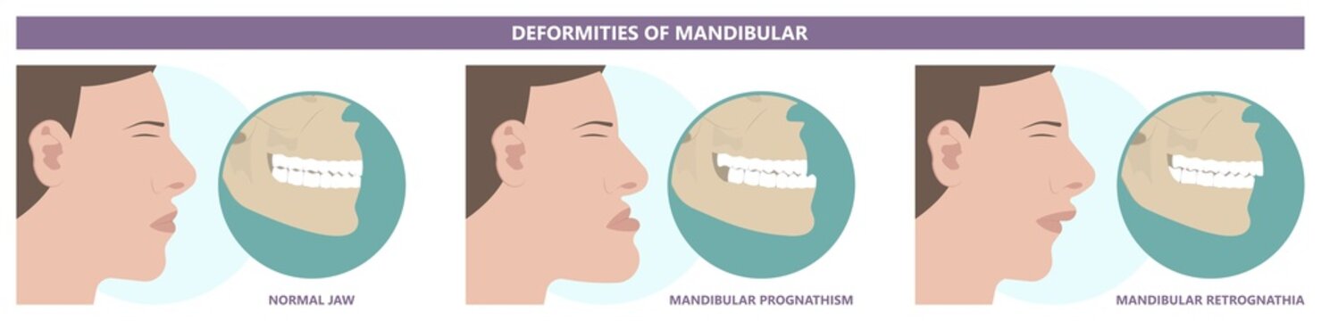 Jaw Surgery chin implant Sleep Apnea snoring upper airway plastic facial Cranio TMD TMJ joint Overbite teeth dental birth defects Open bite pain trauma cosmetic gummy smile bone reconstructive bad