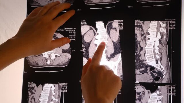 The doctor shows a CT image of the spine of a patient with scoliosis and intervertebral hernia.