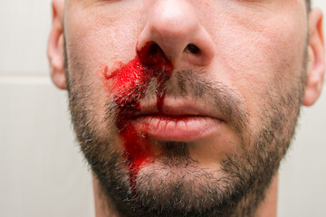 The guy is bleeding from his nose. Blood on the face of an unshaven man. Portrait of a man with a...