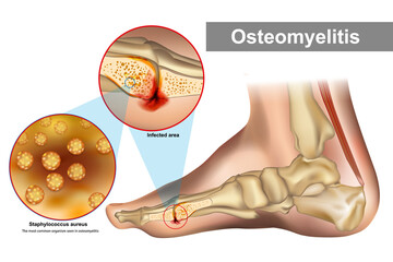 Osteomyelitis is an infection of bone. Staphylococcus aureus most common organism seen in osteomyelitis