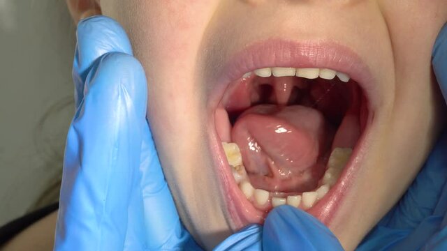 A doctor in blue gloves examines the child's mouth, the tooth is wobbling, followed by a new tooth.