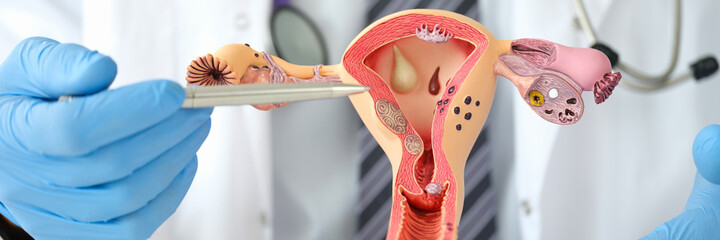 Man gynecologist showing female diseases with pen on plastic artificial model of uterus and ovaries...
