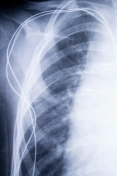 x-ray imagefrom the human chest and pacemaker