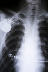 x-ray imagefrom the human chest and pacemaker