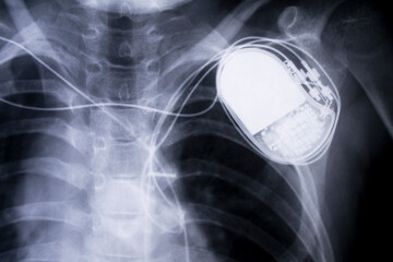 x-ray imagefrom the human chest and pacemaker