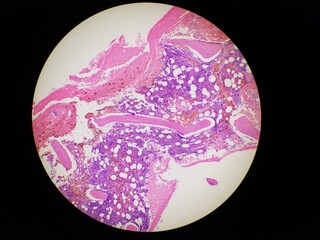 Bone marrow biopsy H and E stain showing eosinophilia