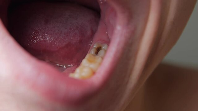 Black tooth caries open mouth