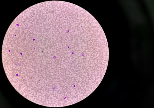 Abnormal microscopic view of hematological slide. Hemoglobin E (HbE) disease