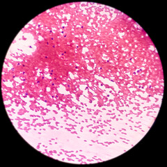 Fine needle aspiration (FNA) cytology of chronic sialadenitis of salivary gland, show cellular material composed of salivary acini, neutrophils and few lymphocytes.