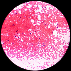 Fine needle aspiration (FNA) cytology of chronic sialadenitis of salivary gland, show cellular material composed of salivary acini, neutrophils and few lymphocytes.