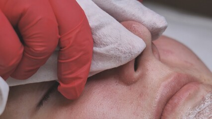 Squeezing acne from a girl with problem skin in the salon.