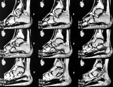MRI Magnetic Resonance scan image of the left foot and ankle