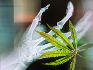 Cannabis leaf and bonescan as potential curation for arthritus