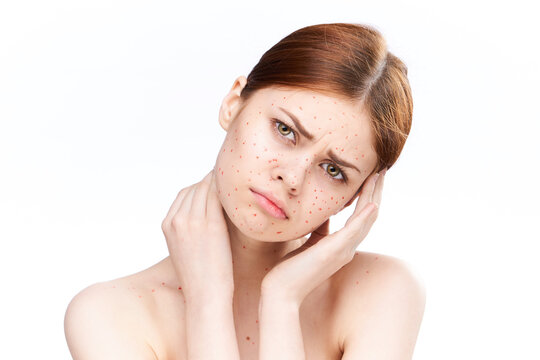 Sad Woman With Bare Shoulders Red Dots On Her Face