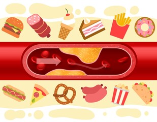 Consequences of fast food. Blood vessel with cholesterol plaque. Harmful nutrition. Atherosclerosis disease. Artery blockage. Cakes or hamburgers. Unhealthy donuts and pizza. Vector concept