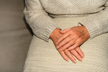 Hands of senior woman with varicose veins
