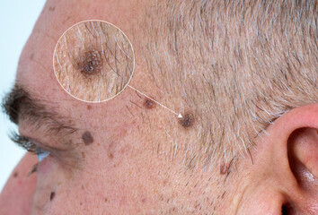 close up the black spot on human skin. Melanoma  is a type of skin cancer develops on human skin from the pigment-producing cells melanocytes. Risk to be skin cancer. - obrazy, fototapety, plakaty
