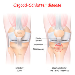Osgood–Schlatter disease. Healthy Joint and Apophysitis of the tibial tubercle