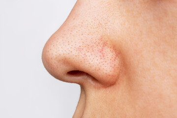 Close-up of a woman's nose with blackheads or black dots isolated on a white background. Acne problem, comedones. Enlarged pores on the face. Profile. Cosmetology dermatology concept - obrazy, fototapety, plakaty