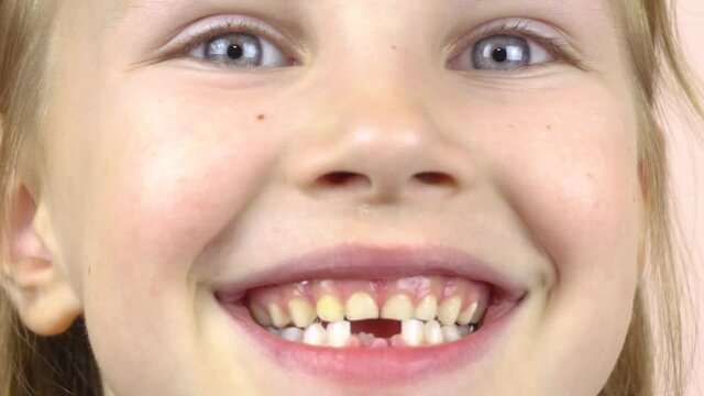 Close-up of the face of a little girl who shows her mouth with fallen milk teeth, grimaces.