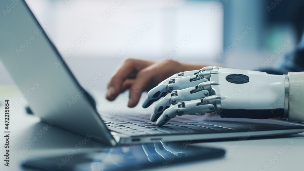 Poster Close-up on Hands: Person with Disability Using Prosthetic Arm to Work on Laptop Computer. Specialist Swift and Natural Use of Thought Controlled Body Powered Myoelectric Bionic Hand.