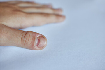 Changing the nail plate on the boy's thumb. Late symptom of coxsackievirus. Symptom of a viral disease.