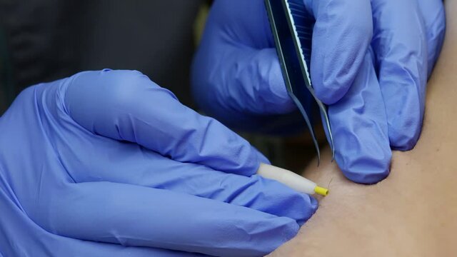 modern treatment of electrolysis hair removal in underarm skin, closeup view