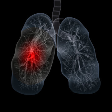 Covid-19 Computed Tomography Of The Lungs. CT Scan