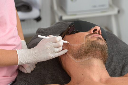 Laser hair removal on mans face. man in a goggles.