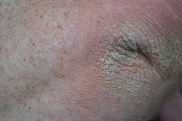 Fototapeta premium Close up dry flaky skin on elbow, caused by psoriasis. High quality photo