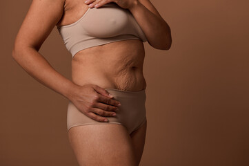Close-up portrait with female body with flaws, stretch marks and cellulite after childbirth due to leading unhealthy lifestyle during pregnancy. Call to love and self-acceptance, body positivity