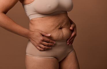 Woman body with stretch marks on the skin after childbirth. The concept of love and acceptance of...
