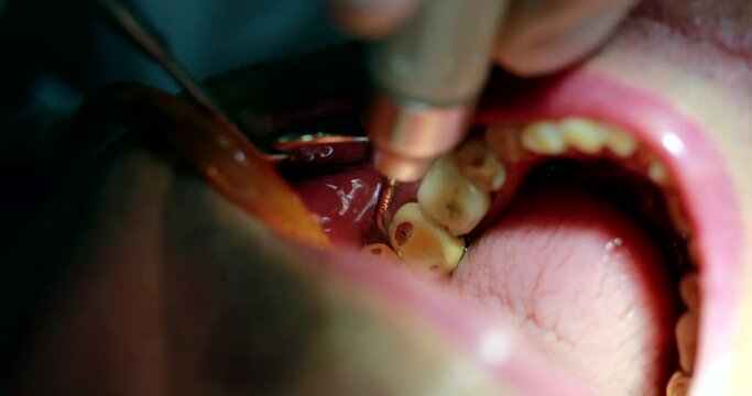 Dental procedure close-up mouth at dentist clinic