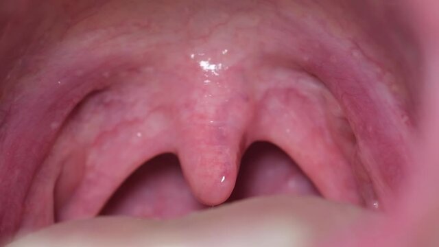 Macro opened his mouth with a sore throat. 